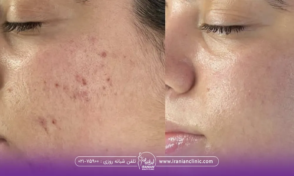 عکس قبل و بعد دختری که میکرونیدلینگ انجام داده است