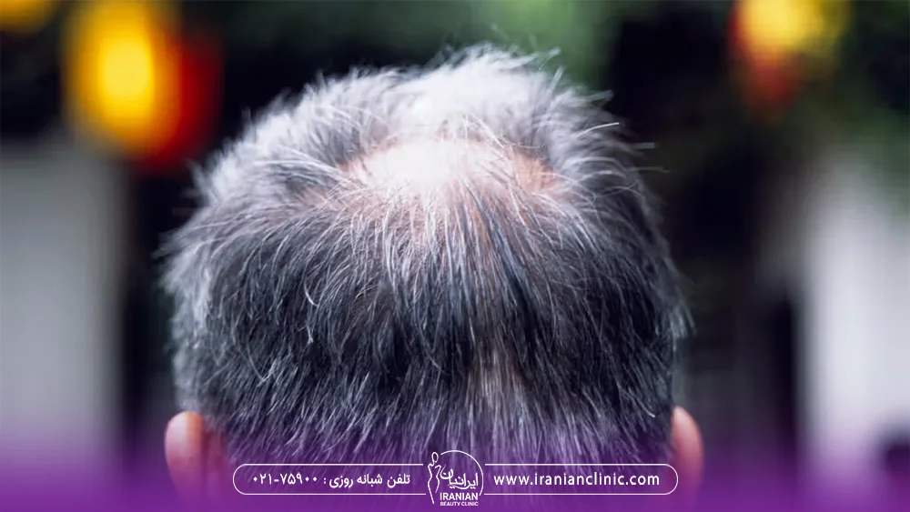 عکس از پشت سر مردی که دچار ریزش مو شده و موهای فرق سر او کم پشت شده است