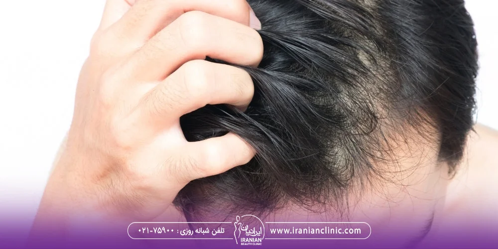 مردی که موهای خود را می خاراند