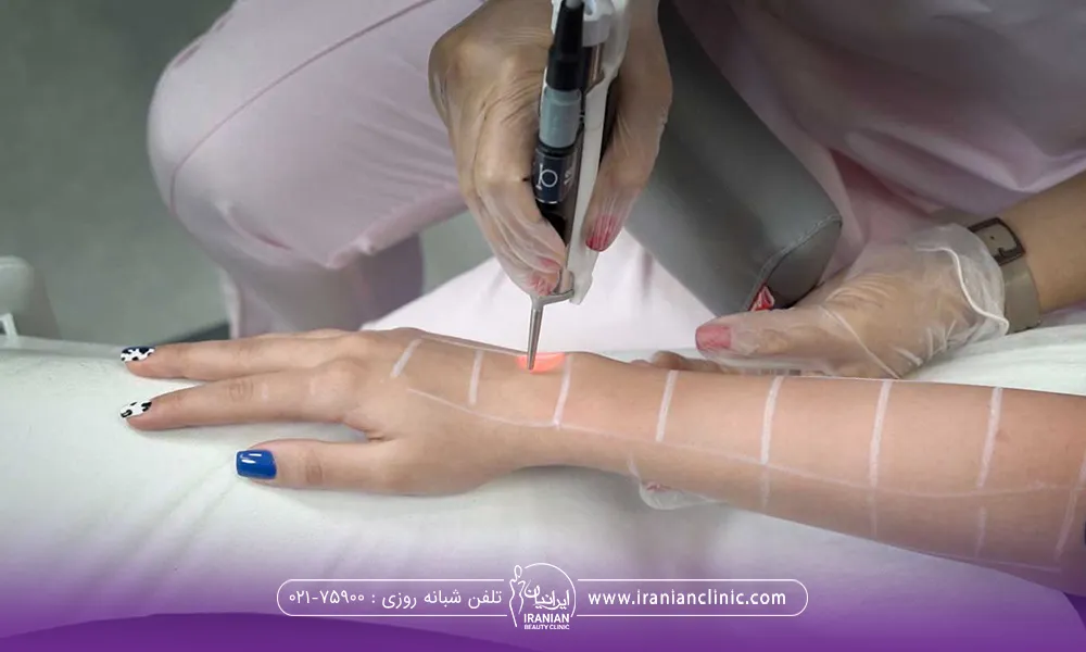 اپراتوری که دست خانمی را گرفته و در حال لیزر کردن دست فرد می باشد
