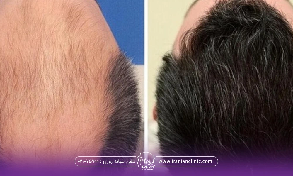 عکس قبل و بعد مردی که کاشت مو انجام داده است