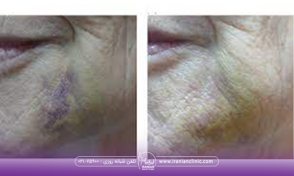 عکس از کبودی صورت فرد در ناحیه فک که رفع شده است