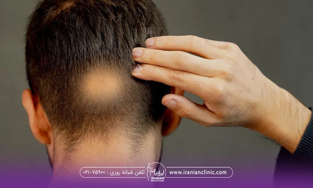 عکس از پشت سر فردی که یک قسمت از پشت سر او بصورت سکه ای دچار ریزش شده است - علت ریزش مو در جوانان
