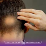 عکس از پشت سر فردی که یک قسمت از پشت سر او بصورت سکه ای دچار ریزش شده است - علت ریزش مو در جوانان