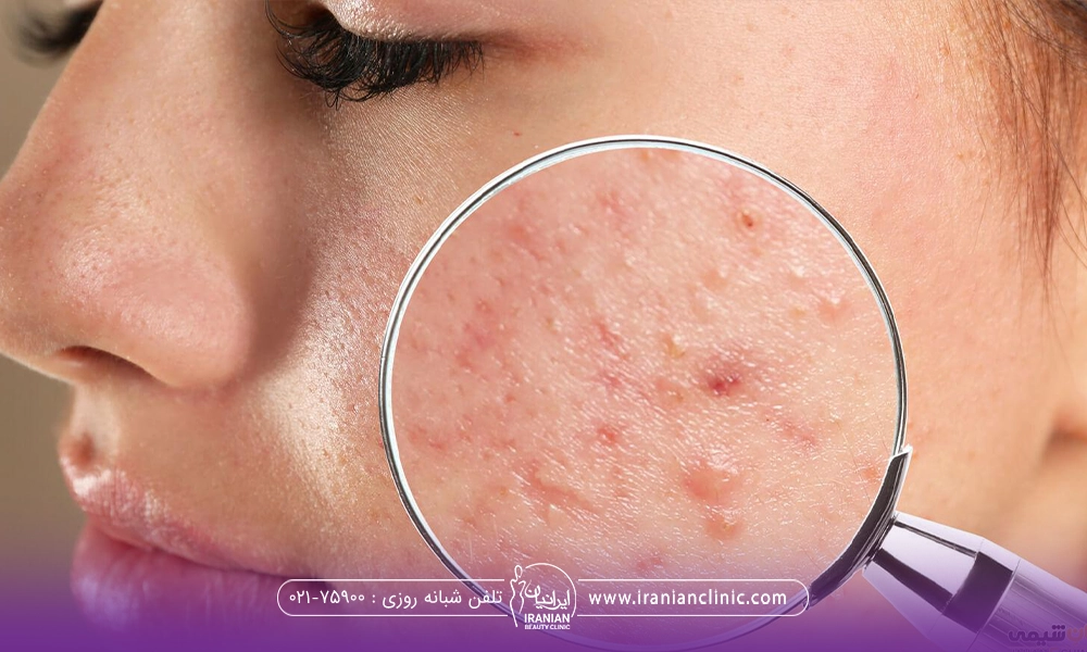 نیمرخ فردی که ذره بین جلوی صورتش گرفته است و جوش های صورتش مشخص است