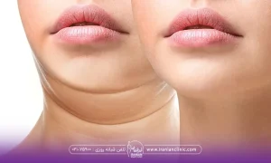 عکس قبل و بعد زنی که برای از بین بردم غبغب خود از روش اندولیفت استفاده کرده است - هزینه اندولیفت غبغب