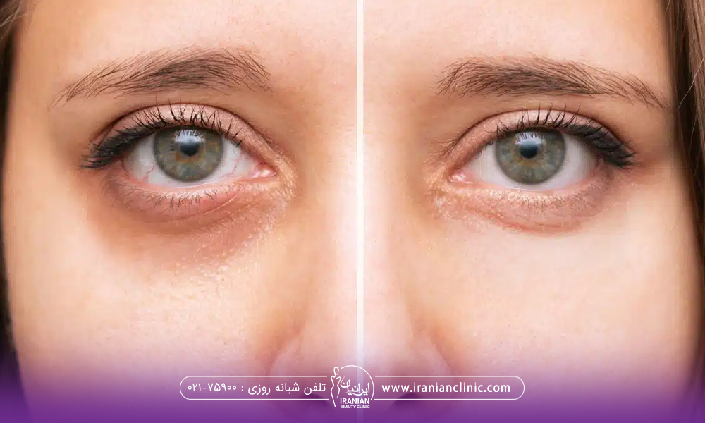 عکس قبل و بعد فردی که پی ار اف انجام داده است و گودی زیر چشم او رفع شده است