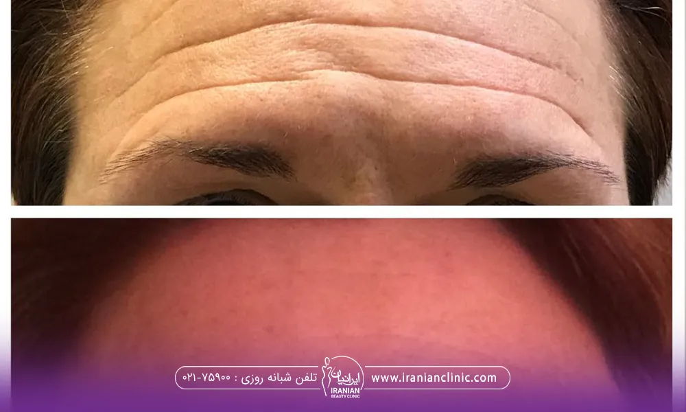 عکس قبل و بعد فردی که برای خطوط پیشانی خود از تزریق ژل استفاده کرده است
