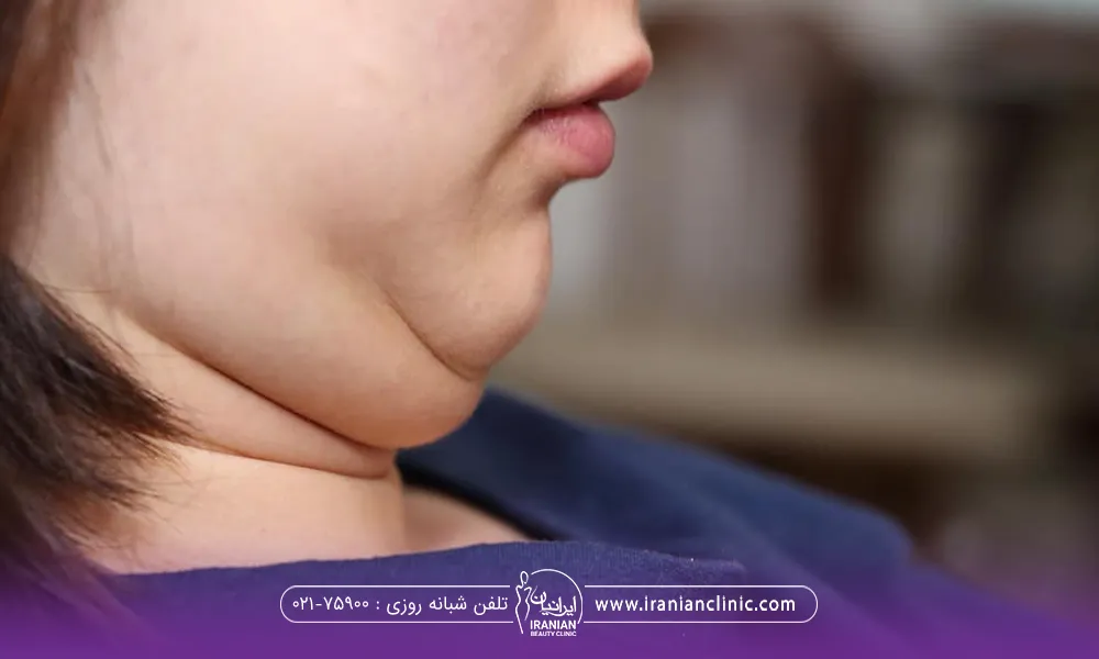 عکس دختری که سر خود را پایین گرفته و غبغب بزرگی دارد