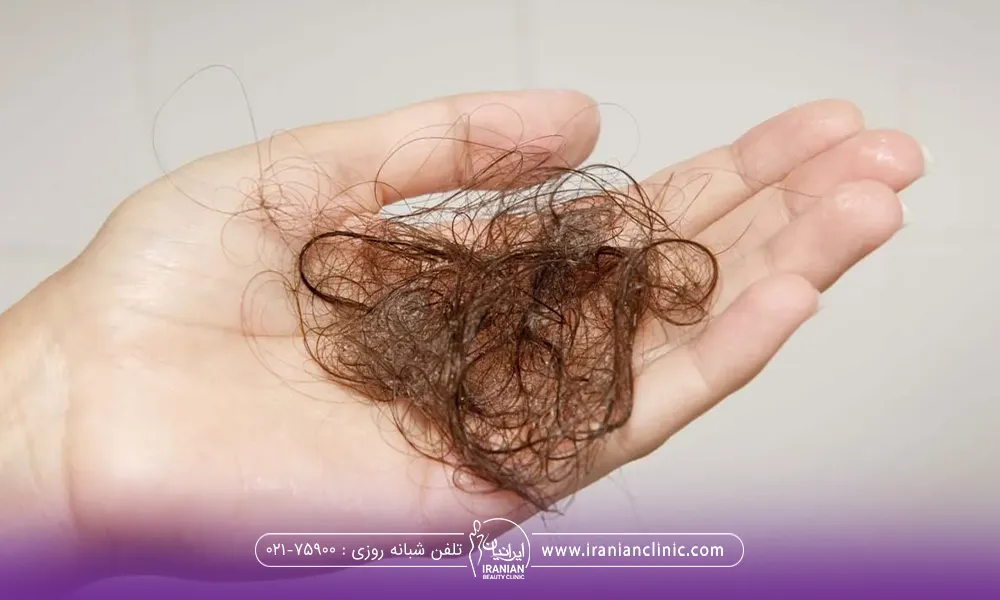 یک دسته موی ریخته در دست فردی