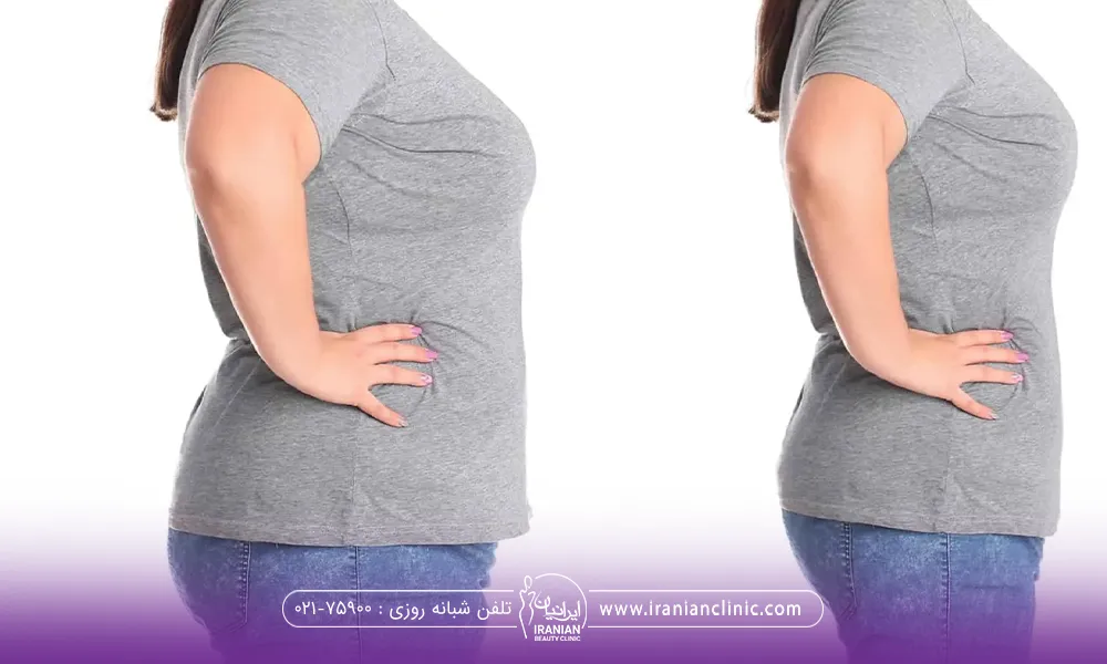 عکس قبل و بعد زنی که عمل بای پس معده انجام داده است