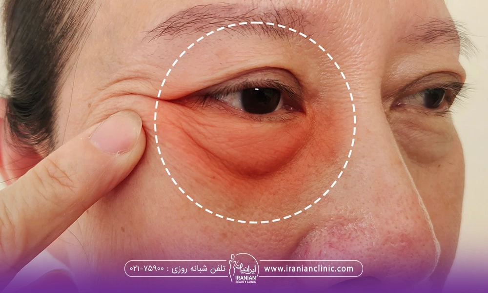خانمی که دور چشمش یک دایره کشیده شده و با دست زیر چشمش را نگه داشته و زیر چشمش قرمز و متورم است - عوارض فيلر زير چشم