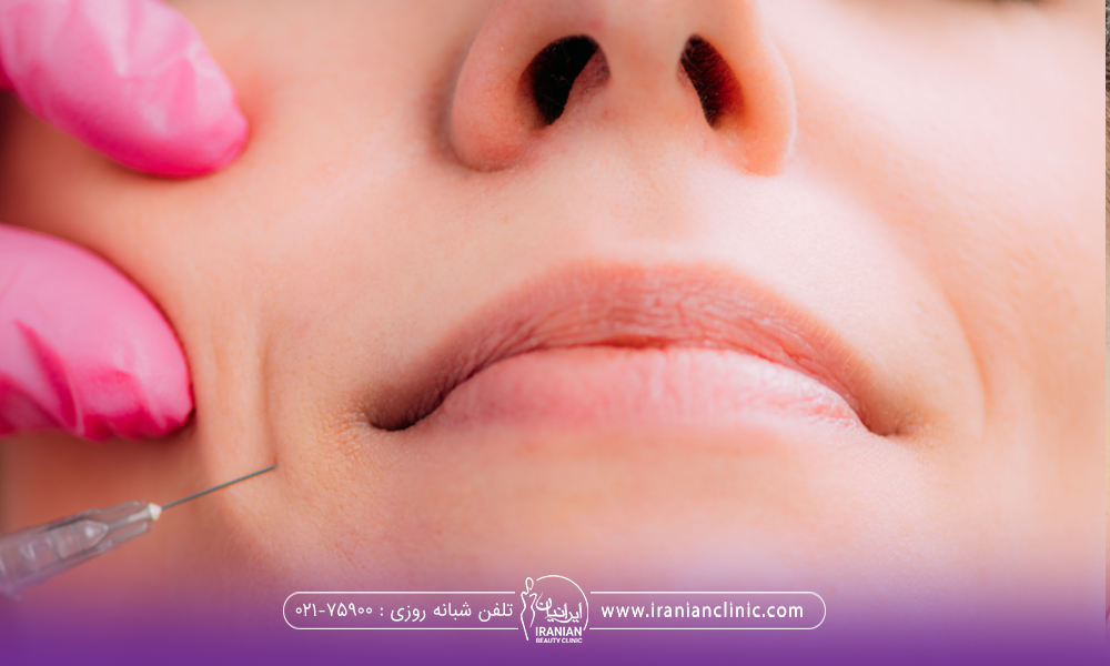 دست دکتری که در حال تزریق فیلر به خط خنده فرد است
