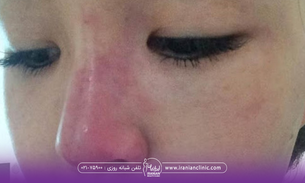 بینی دختری که بعد از تزریق فیلر قرمز شده است