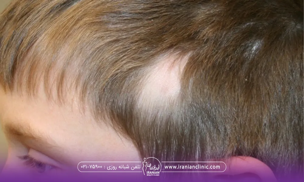 قسمتی از موی سر کودک به صورت سکه ای ریخته شده است