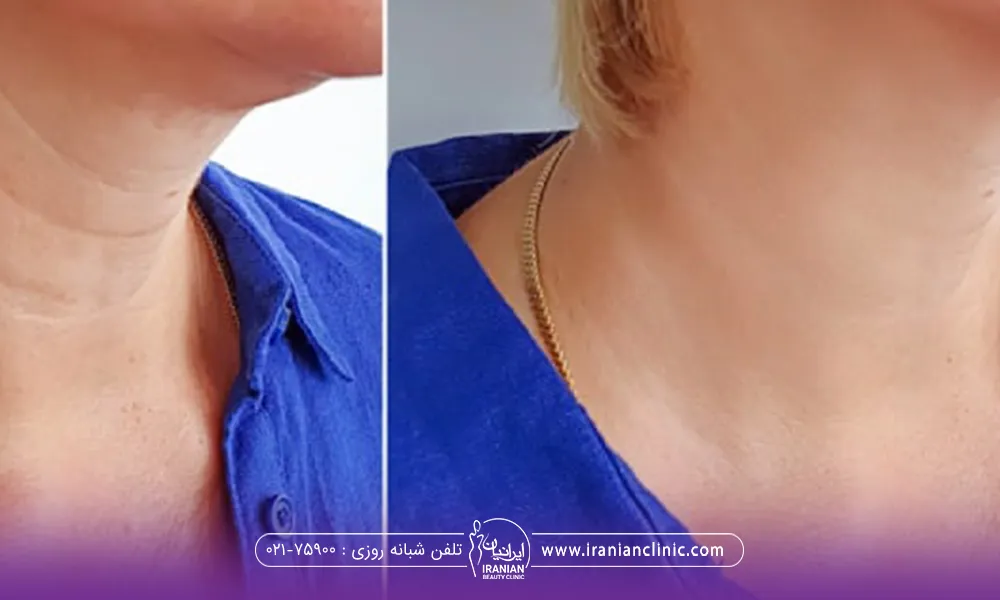 قبل و بعد فردی که تزریق مژول انجام داده است