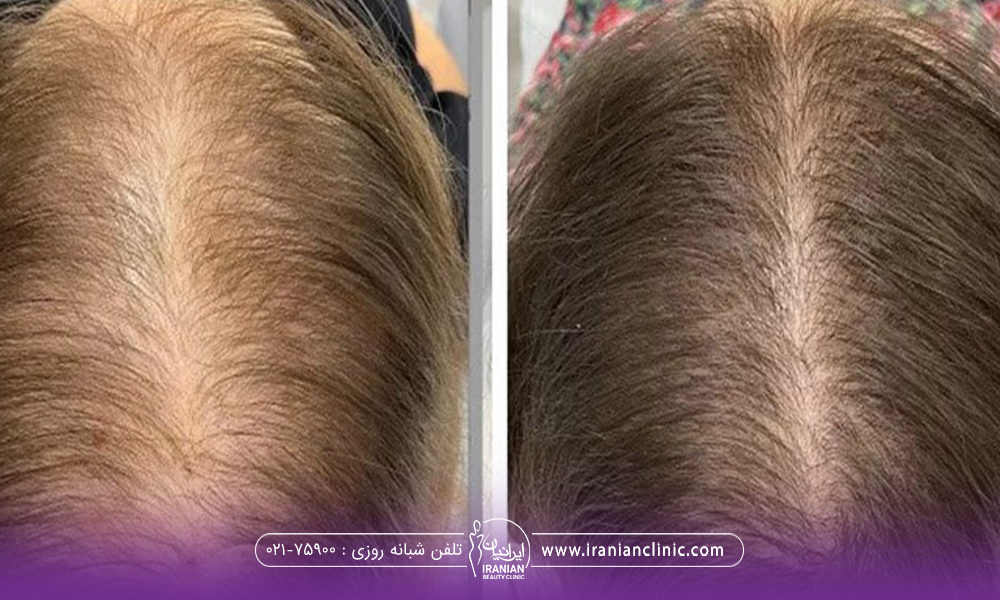 عکس قبل و بعد فردی که کربوکسی تراپی مو انجام داده است