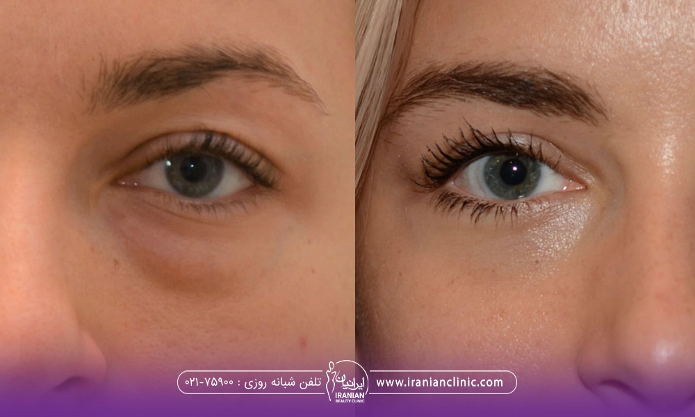 عکس قبل و بعد دختری که عمل بلفارو پلک پایین انجام داده است