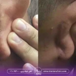 عکس قبل و بعد درمان کلوئید گوش