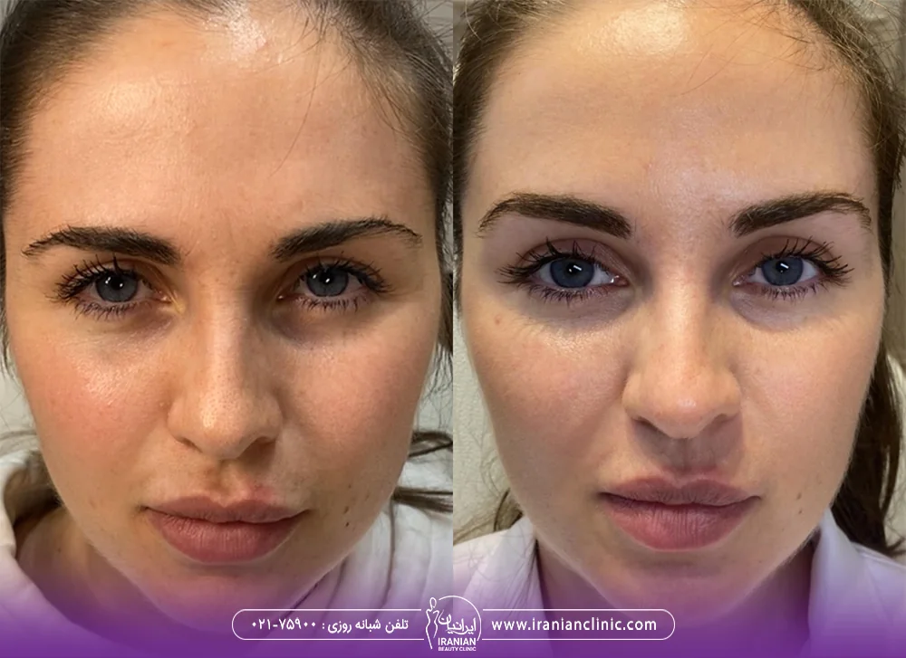 عکس قبل و بعد لیفت ابروی دختر با تزریق فیلر