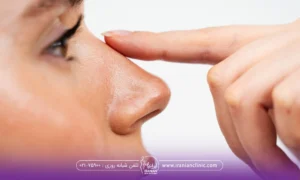 فردی که کمی سرش را بالا گرفته است و انگشت یک دستش روی بینی اش است - تا چند روز بعد عمل بینی باید سربالا باشد؟