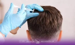 عکس از پشت سر فردی که نشسته و دست دکتری که دستکش آبی به دست دارد و در حال مزوتراپی موهای او است - مزوتراپی بعد از کاشت مو