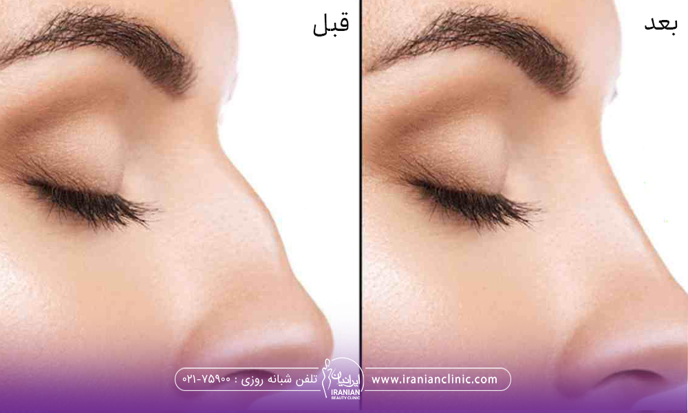 عکس قبل و بعد فردی که عمل بینی انجام داده است