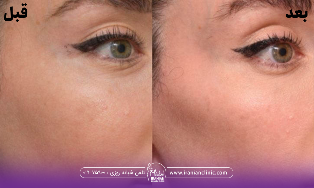 عکس قبل و بعد فردی که تزریق ژل به گونه انجام داده است