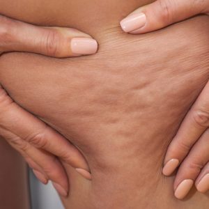 رفع سلولیت و عضله سازی ران ها