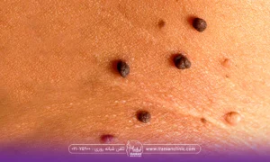 پوست فردی که روی آن چند خال گوشتی وجود دارد
