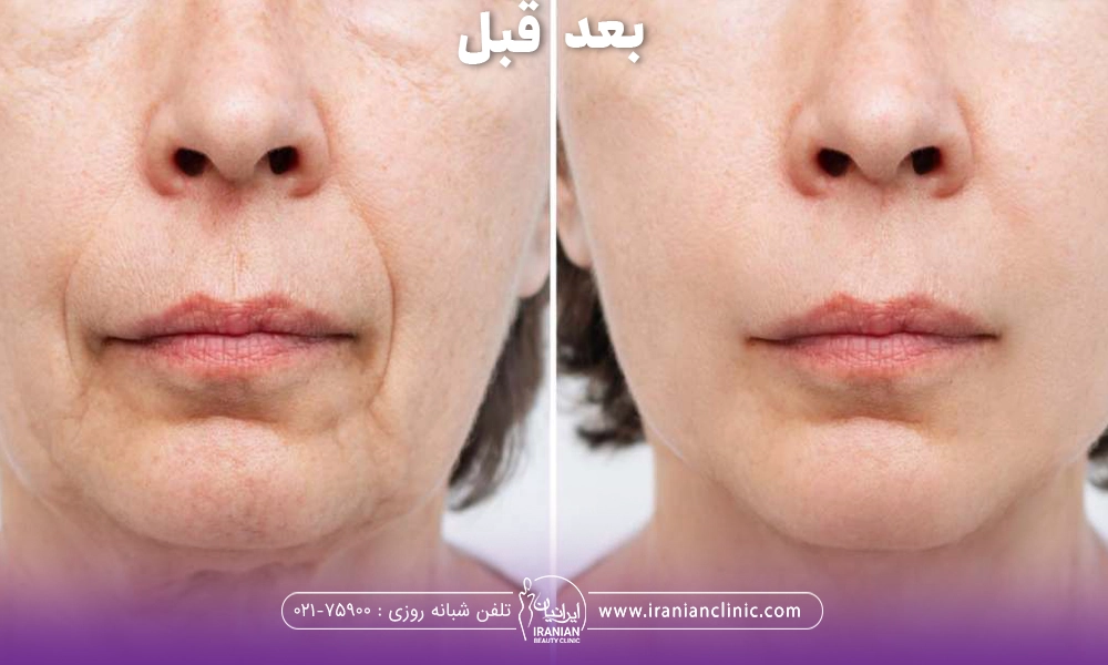 عکس قبل و بعد فردی که فرکشنال صورت انجام داده است
