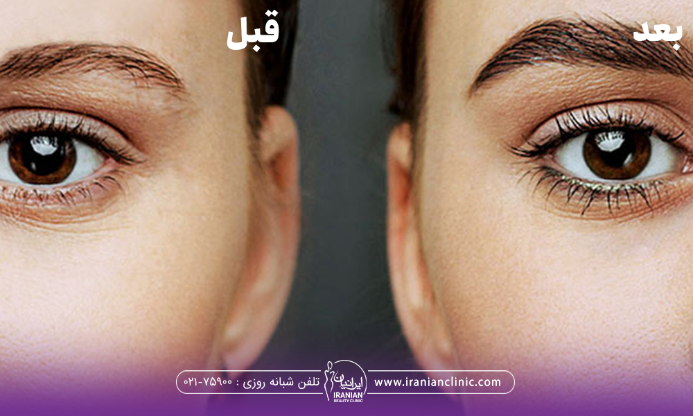 عکس قبل و بعد ابروهای دختری که کاشت انجام داده است و بعد از کاشت ابروهای او پرپشت تر و زیباتر شده است