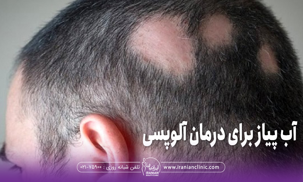 پشت سر مردی که دچار آلوپسی شده است و چند نقطه از سر او به صورت سکه ای دچار ریزش مو شده است