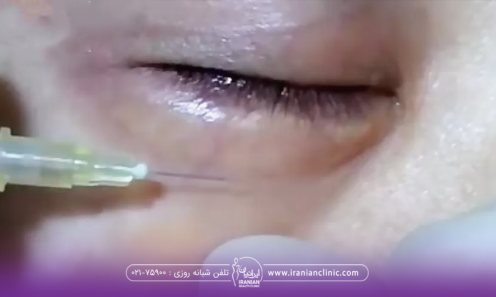 فرآیند کربوکسی تراپی زیر چشم فرد