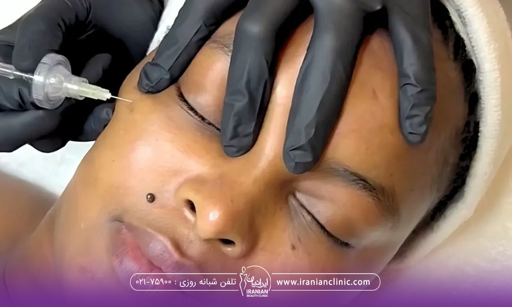 خانمی که خوابیده و چشم هایش بسته است و دست دکتری که روی صورت خانم است و با دست دیگر در حال انجام کربوکسی تراپی است - بهترین مرکز کربوکسی تراپی در تهران