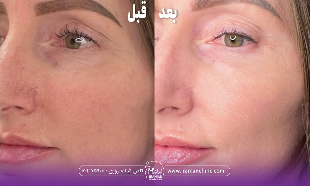 عکس قبل و بعد دختری که کربوکسی تراپی انجام داده است
