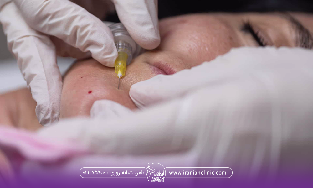 عکس نزدیک از صورت دختری که پزشک روی چانه او کربوکسی تراپی انجام می دهد