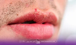 مردی که بعد از تزریق ژل لب روی لب بالایش دانه های سفید رنگ زده است - دانه های سفید روی لب بعد از تزریق ژل​