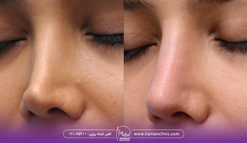 عکس قبل و بعد دختری که فیلر بینی تزریق کرده است