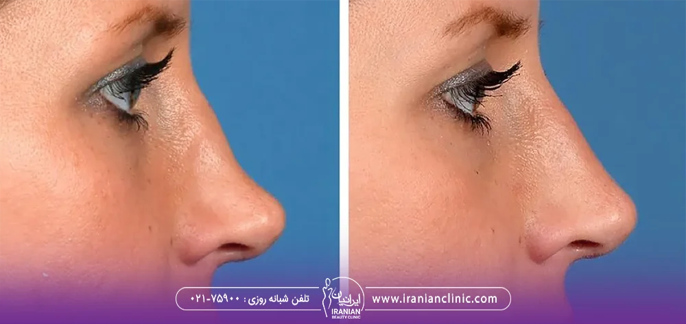 عکس قبل و بعد صورت دختری که فرورفتگی بینی خود را با تزریق فیلر رفع کرده است