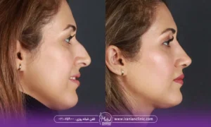 عکس زن قبل و بعد عمل بینی - تغذیه بعد از عمل بینی