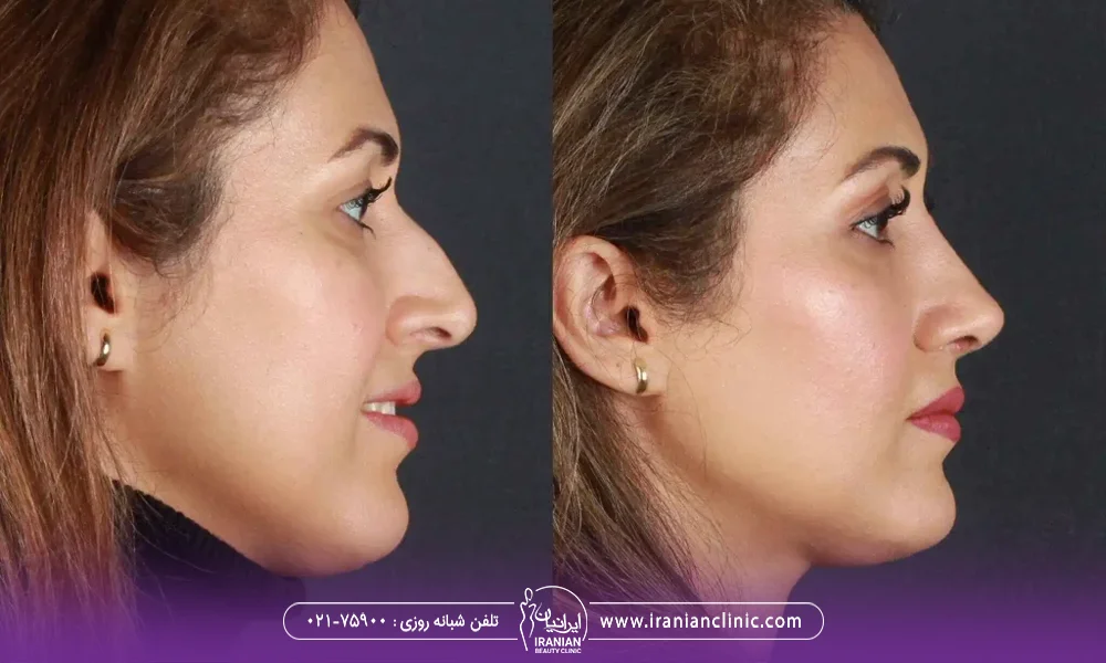 عکس زن قبل و بعد عمل بینی - تغذیه بعد از عمل بینی