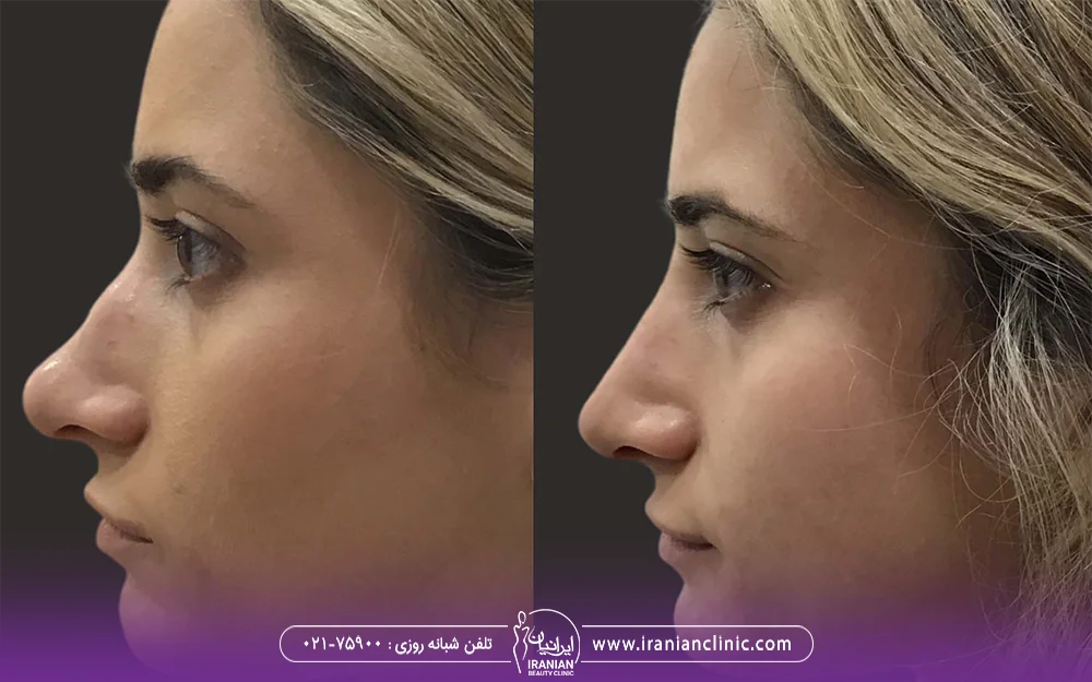 عکس قبل و بعد تزریق فیلر بینی
