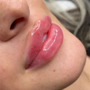 ژل لب روسی (درمال استایل)