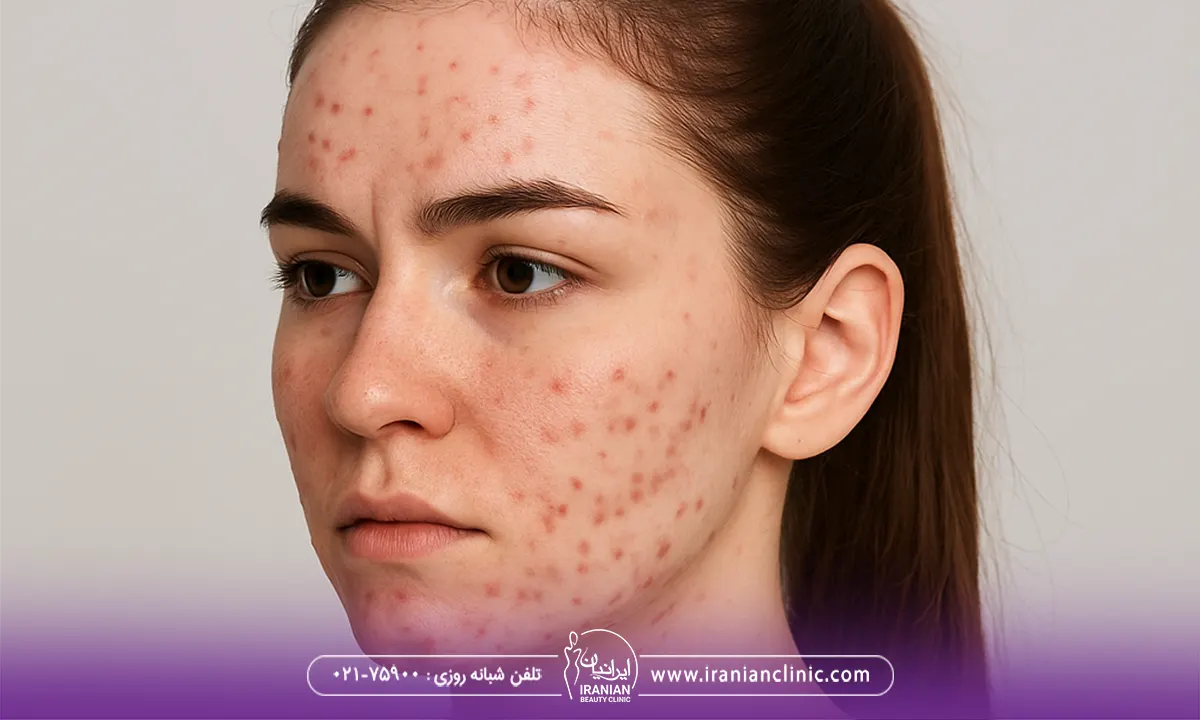 انواع جوش صورت