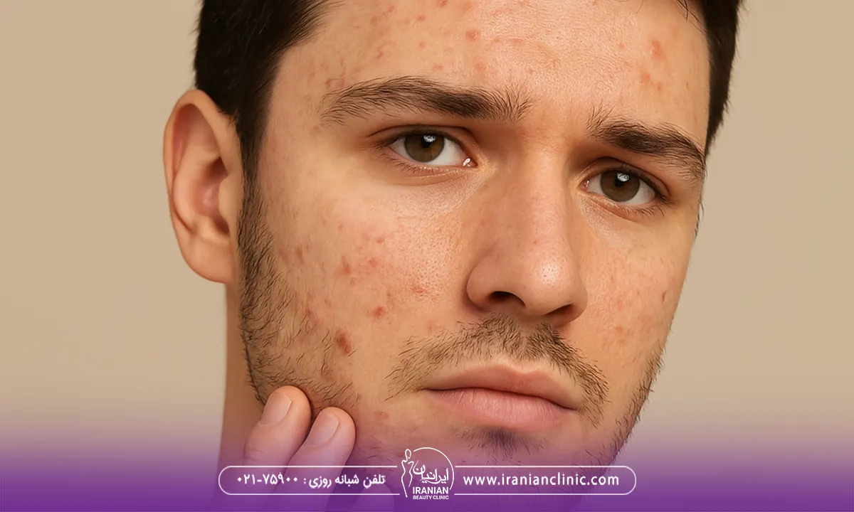 چرا جوش صورت به وجود می‌آید؟