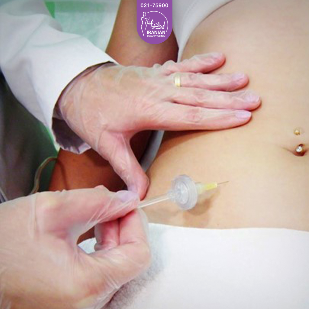 دست دکتری که روی شکم فرد است و در حال انجام کربوکسی تراپی است - کربوکسی تراپی شکم