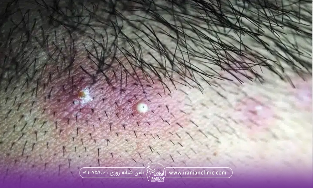 خط رویش سر فردی که در ناحیه رشد مو جوش زده است