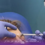 دکتری که در حال انجام تزر یق بوتاکس در ناحیه پیشانی است-نقاط تزریق بوتاکس