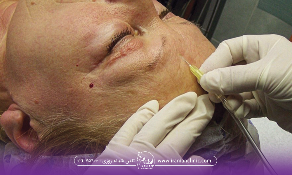 دست دکتری که در حال انجام کربوکسی تراپی روی پیشانی مراجعه کننده خانم است